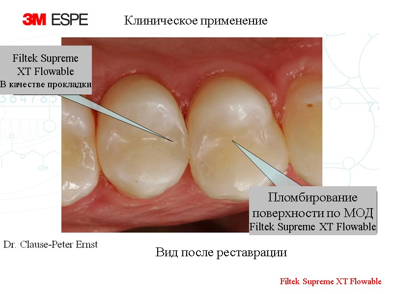 Filtek Supreme XT Flowable В качестве прокладки Пломбирование поверхности по МОД Filtek Supreme XT